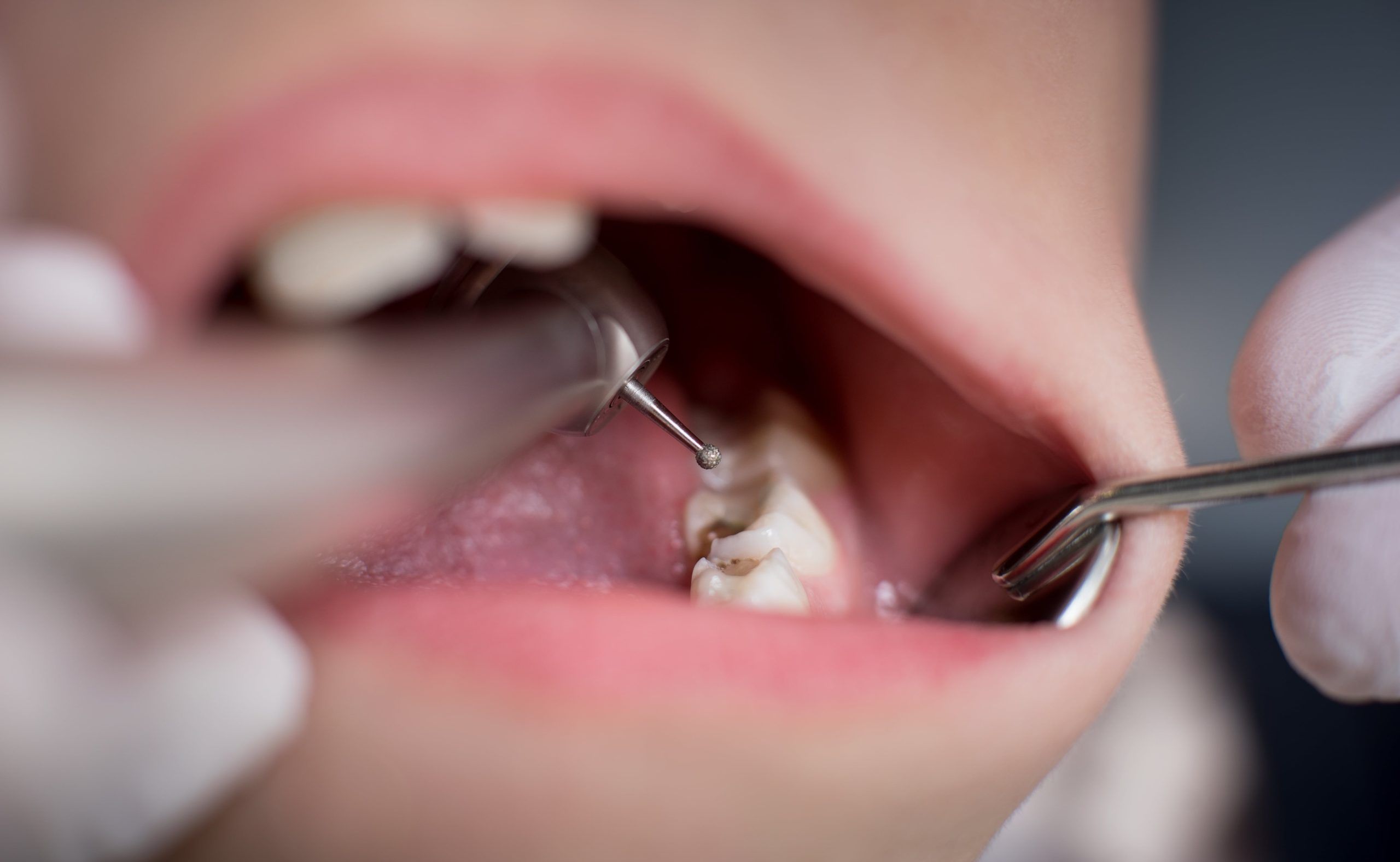 endodoncia